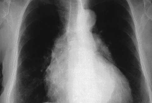 Cardiopat�a hipertensiva