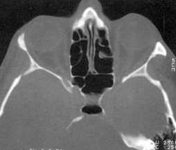 corte axial