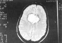 Glioma