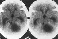 Hemangioma