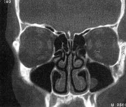 TAC coronal. Seno etmoidal.