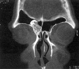 TAC coronal. Seno frontal