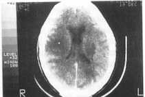 Toxoplasmosis