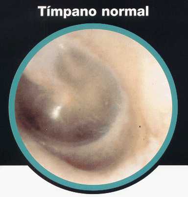 T�mpano normal