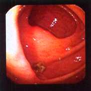 V�lvula ileocecal