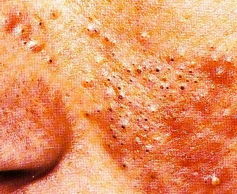 ACNE VULGAR