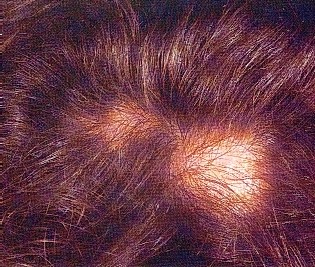 ALOPECIA