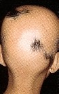 ALOPECIA AREATA