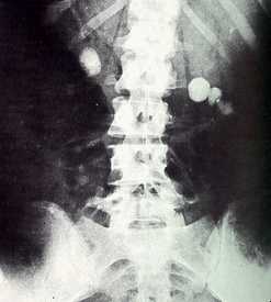 Nefrolitiasis