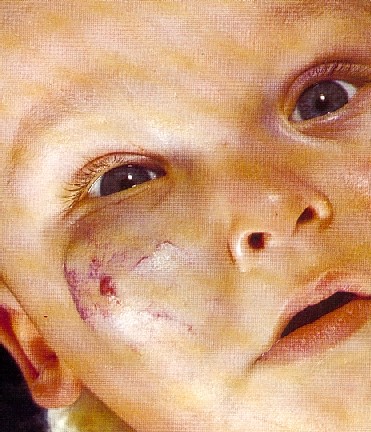HEMANGIOMA