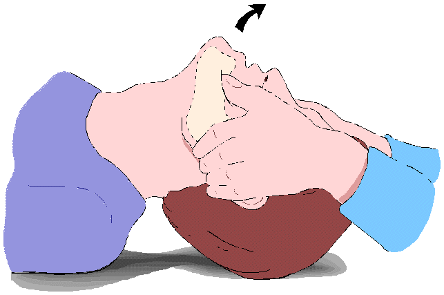 Hiperextensi�n de la cabeza