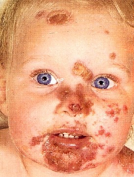 IMPETIGO