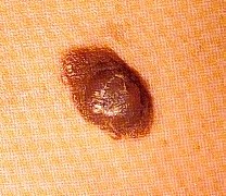MELANOMA