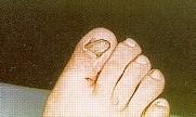 ONICOMICOSIS