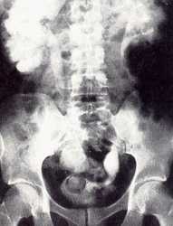 Ureteroceles bilaterales