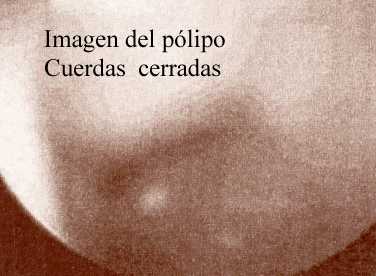 Cuerdas vocales