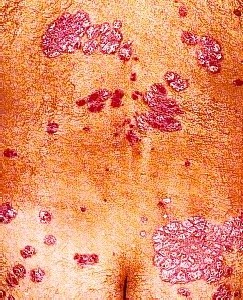 PSORIASIS VULGAR