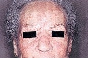 QUERATOSIS ACTINICA