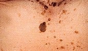 QUERATOSIS SEBORREICA