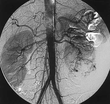 Arteriografia renal