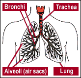 BRONQUITIS