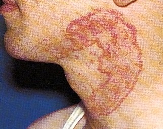 TINEA CORPORIS