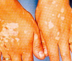 VITILIGO