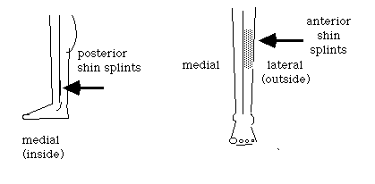 Shin Splints