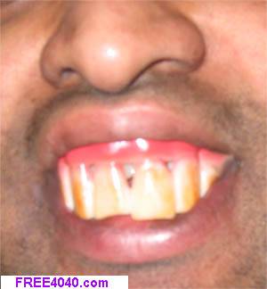 billy bob buck teeth dirty tooth dentures missing dentist gum disease