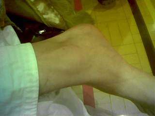 Ahmed's broken foot