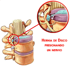 Hernia de Disco