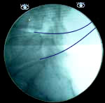 X-ray