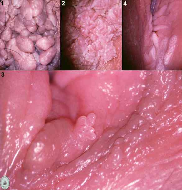 condiloma vulvar condiloma vulvar