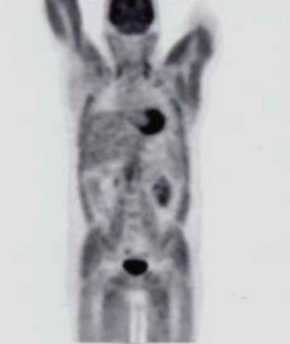 pet scan individual.jpg (53729 bytes)