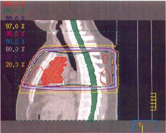 tumor2.jpg (68880 bytes)