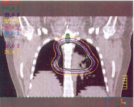 tumor3.jpg (64917 bytes)