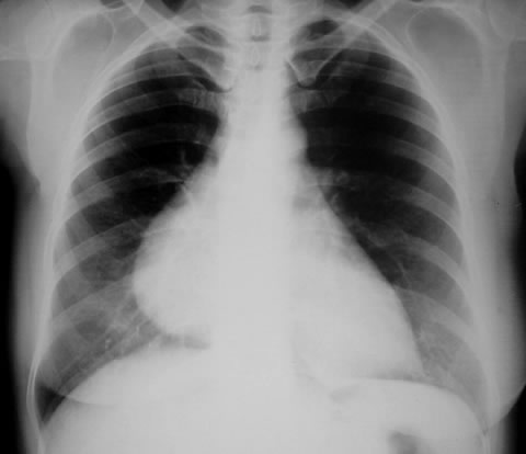 lipoma graso en la caja torácica