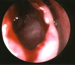 right side concha bullosa opened