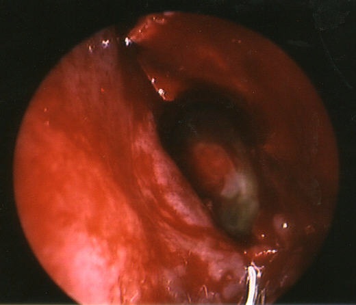 sphenoidotomy; left nasal cavity