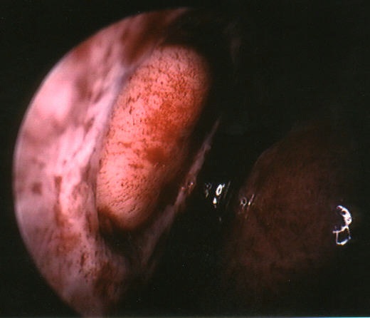 The septum is to the left.&nbsp; This is a left nasal cavity.&nbsp; The white oval is a septal perforation which has been "filled in" with a graft.