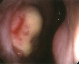 This is the same patient as above.&nbsp; The white oval now has red streaks which are new blood vessels.&nbsp; The pink area is mucosa.