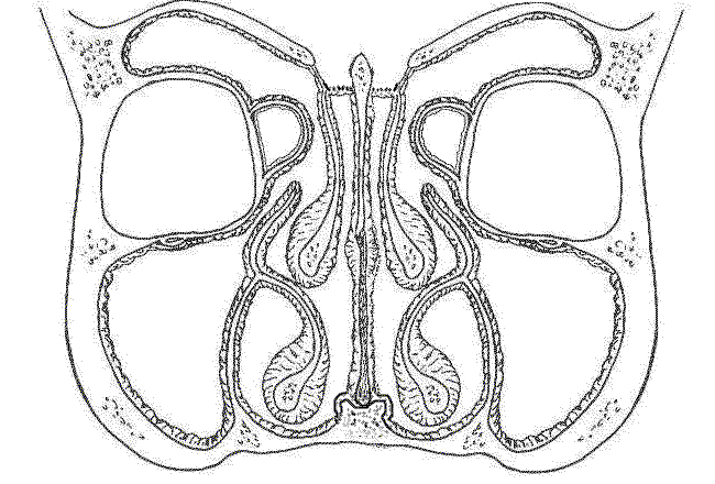 Coronal section through the nose/sinuses/head